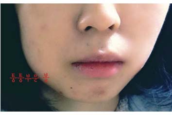 치아교정후기3.jpg