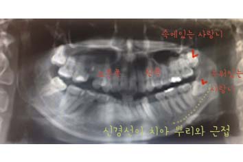 치아교정후기2.jpg