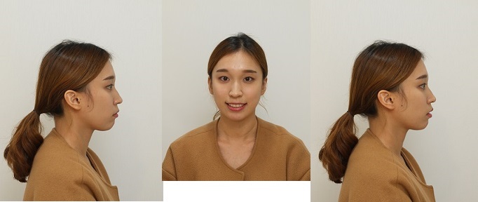 급속돌출입교정_2.jpg