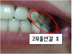 고무줄연결.jpg