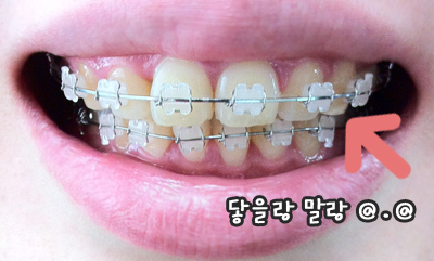 치아교정후기_전1.jpg