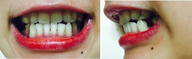 교정후기 23_1.jpg