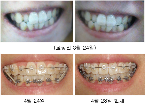 교정시술전 copy.jpg