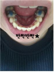 하악사진.jpg