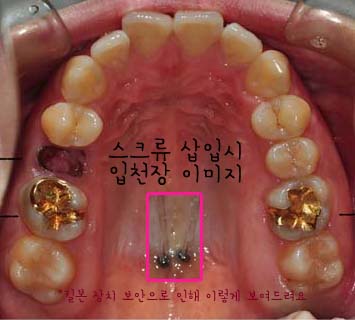 치아교정후기6.jpg