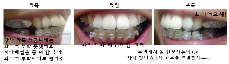 치아교정후기1.jpg