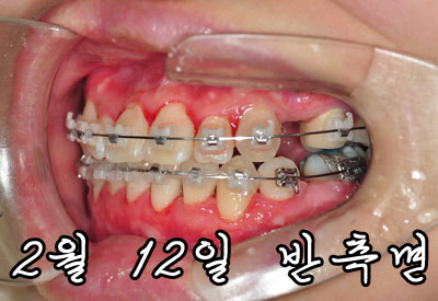 2월후기반측.jpg
