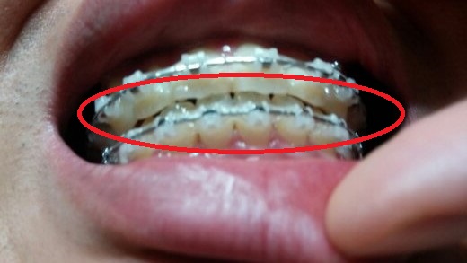 턱관절치아교정후기23화사진4.jpg