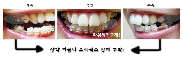 치아교정후기1.jpg