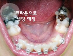 치아교정후기2.jpg