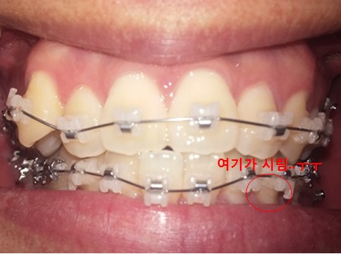 치아교정후기10화사진5.jpg