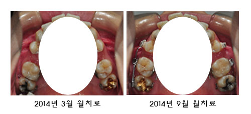 치아교정후기2.jpg