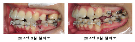 치아교정후기5.jpg