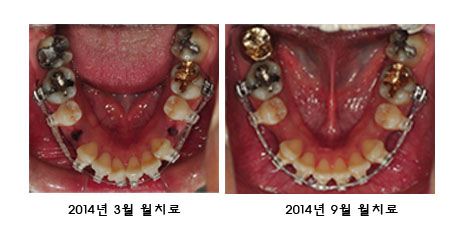 치아교정후기3.jpg