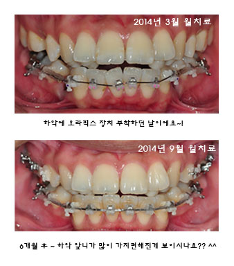 치아교정후기1.jpg