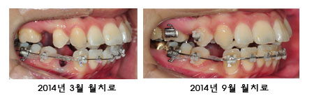 치아교정후기4.jpg