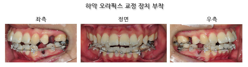 치아교정후기2.jpg
