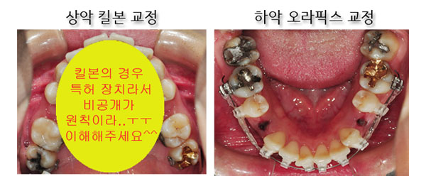 치아교정후기1.jpg