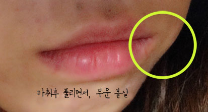 치아교정후기05.jpg