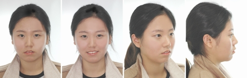 1 교정전얼굴사진.jpg