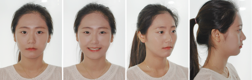 2 교정후얼굴사진.png
