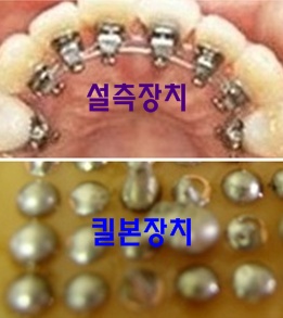 설측납땜-.jpg