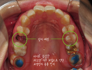 치아교정후기07.jpg