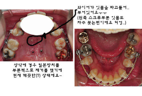 치아교정후기2.jpg