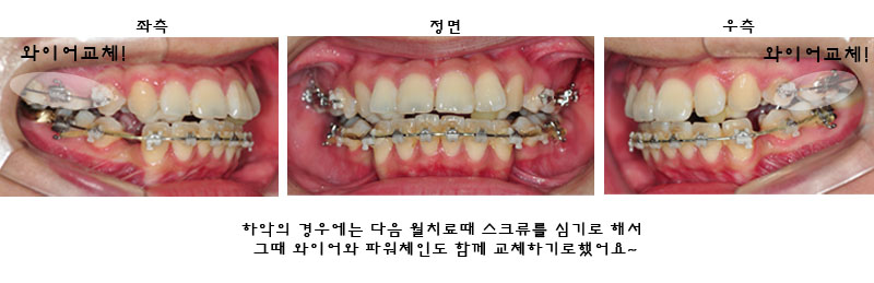 치아교정후기1.jpg