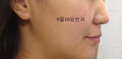 치아교정후기3.jpg