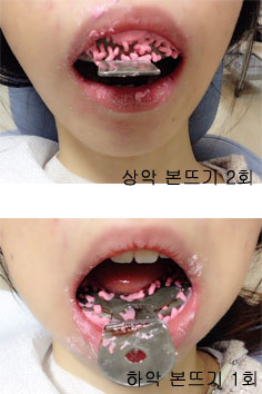 치아교정후기4.jpg