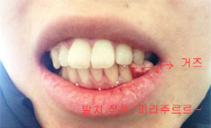 치아교정후기6.jpg