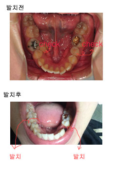 치아교정후기7.jpg