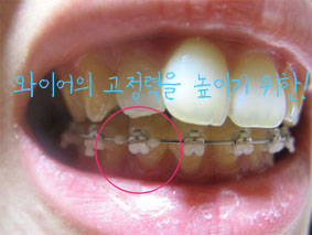 치아교정후기05.JPG