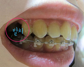 치아교정후기04.JPG