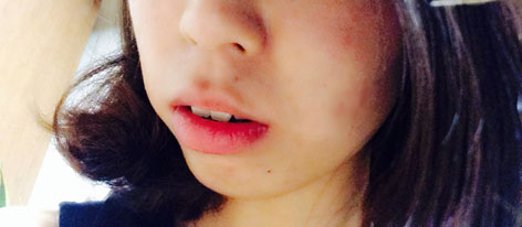 치아교정후기08.JPG