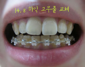 치아교정후기06.jpg