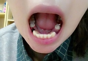 급속돌출입교정10.jpg