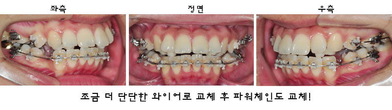 치아교정후기1.jpg