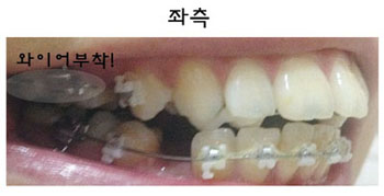 치아교정후기2.png