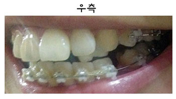 치아교정후기3.png