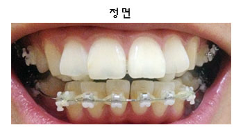 치아교정후기1.png