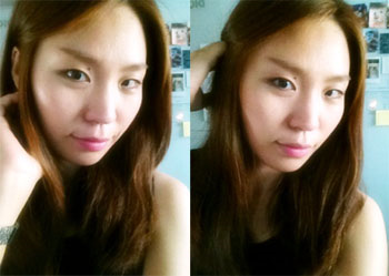치아교정후기6.png