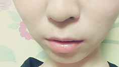 치아교정후기01.JPG