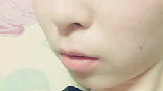 치아교정후기02.JPG
