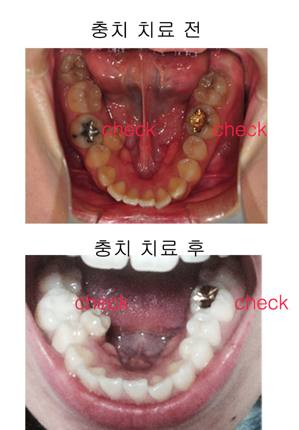 치아교정후기3.jpg