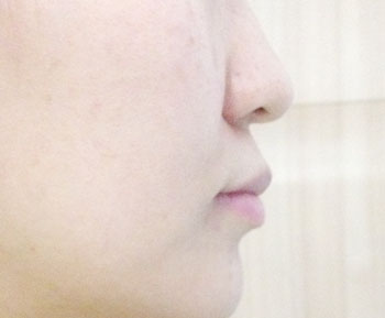 치아교정후기5.jpg