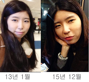 치아교정후기5.jpg