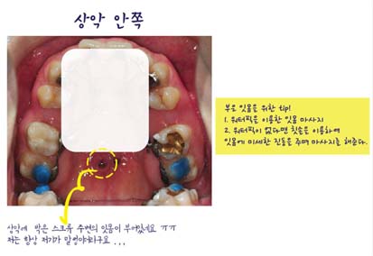치아교정후기04.jpg