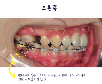 치아교정후기02.jpg